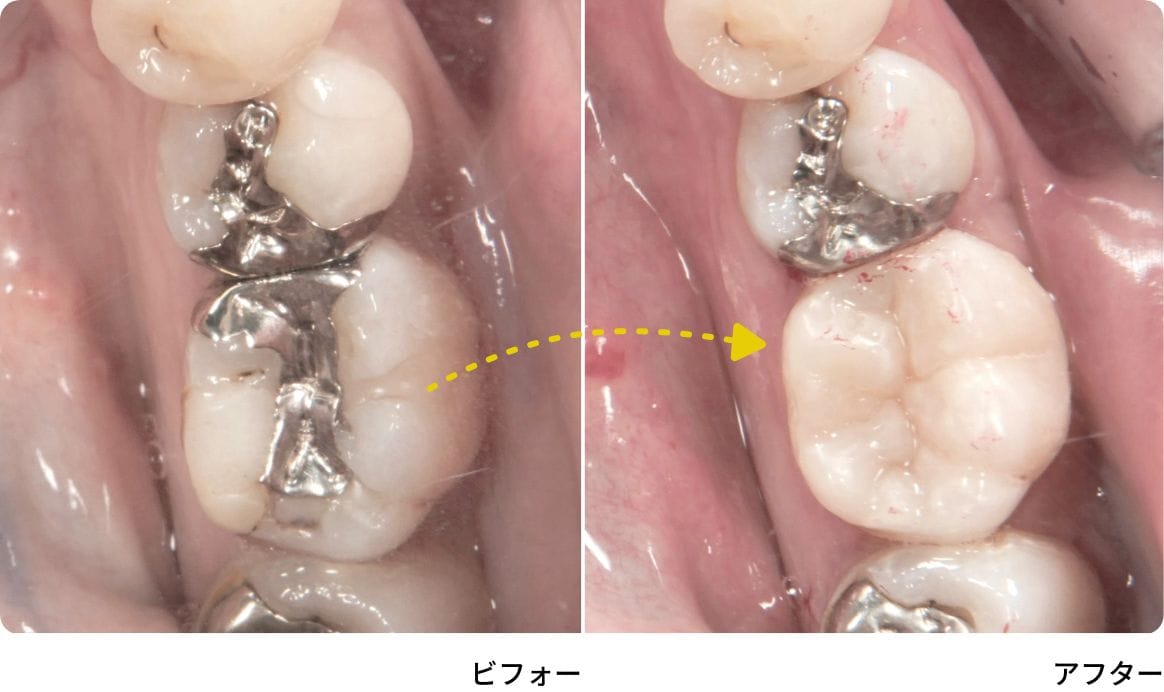 大イレクトボンディングイメージ図