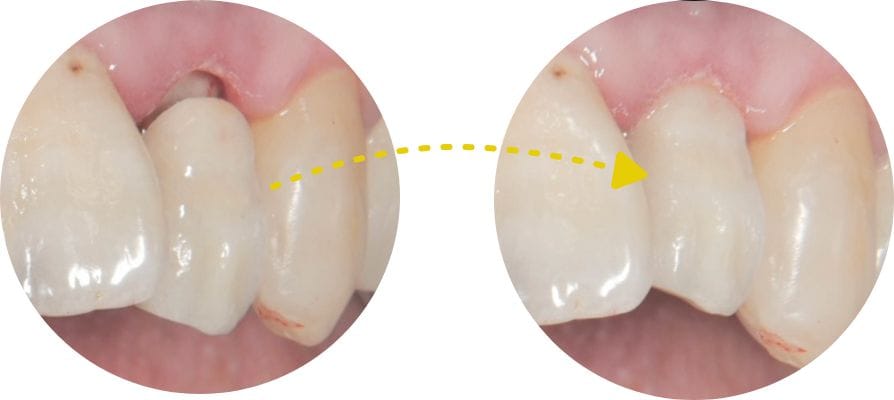 補綴治療イメージ図
