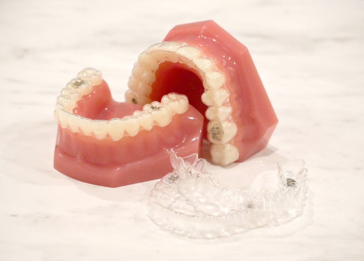 インビザライン矯正イメージ図