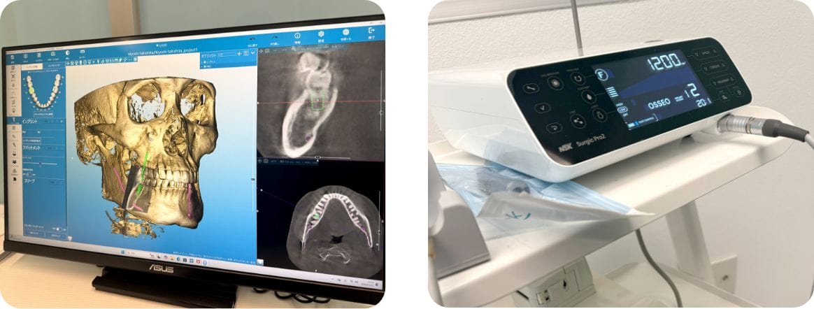 インプラント治療イメージ図