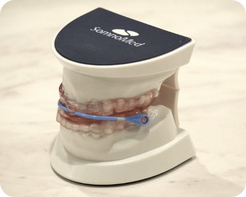 睡眠時無呼吸症候群用オーラルアプライアンスイメージ図